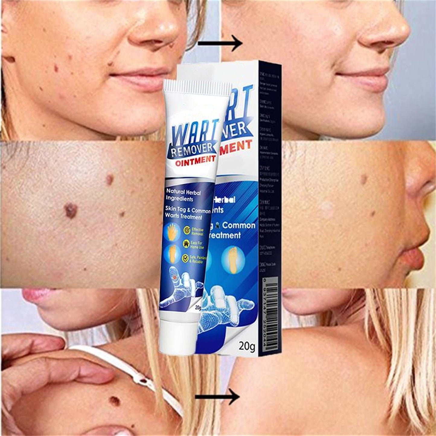 Wart Remover cream-H1