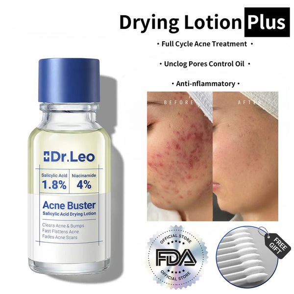 Drying Lotion Plus | Acne & Pimple Treatment | Visibly Shrinks Pimples in 24 Hours & Helps Fade Acne Marks in 7 Days - A926