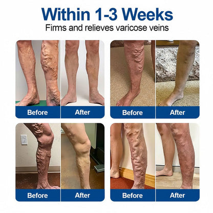 VERVEBEAD™🧑‍⚕️ Vein Ease Microneedle Patch -Visible Vein Reduction in 7 Days, No Clinic, No Compression Socks, Just sleep-ABB8