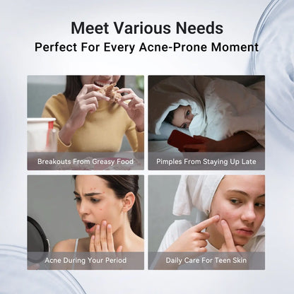 Drying Lotion Plus | Acne & Pimple Treatment | Visibly Shrinks Pimples in 24 Hours & Helps Fade Acne Marks in 7 Days - A926