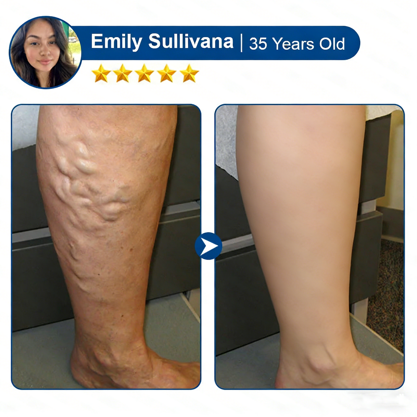 Vervebead™Vein ContourMicroneedle Patch with AdvancedDiosmin & Hesperidin Delivery 🌿 7-Day Visible Results for VaricoseVeins-923