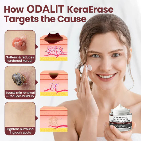 Flash Sale - ODALIT®KeraErase Dual-Action Renewal Cream-GD
