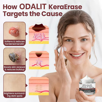 Flash Sale - ODALIT®KeraErase Dual-Action Renewal Cream-GD