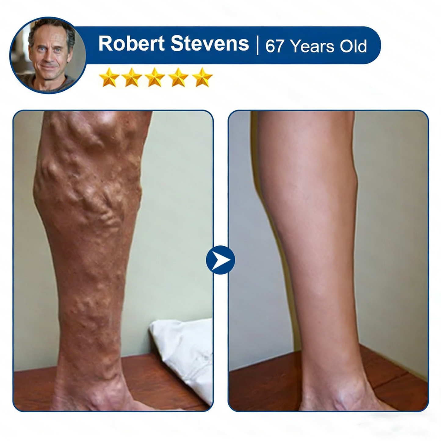 Vervebead™Vein ContourMicroneedle Patch with AdvancedDiosmin & Hesperidin Delivery 🌿 7-Day Visible Results for VaricoseVeins-923