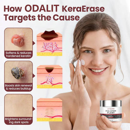 ✅⏰Hot Sale 50% OFF🎁-Flash Sale - KeraErase Dual-Action Renewal Cream