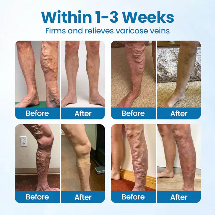 🇺🇸👨‍⚕️✅ VERVEBEAD® Varicose Veins Relief Cream — Visible Vein Reduction in 7 Days, No Clinic, No Compression Socks, Just Apply & Massage ⚡-ABB8