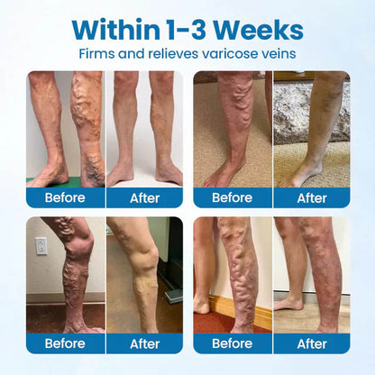 🇺🇸👨‍⚕️✅ VERVEBEAD® Varicose Veins Relief Cream — Visible Vein Reduction in 7 Days, No Clinic, No Compression Socks, Just Apply & Massage ⚡-ABB8