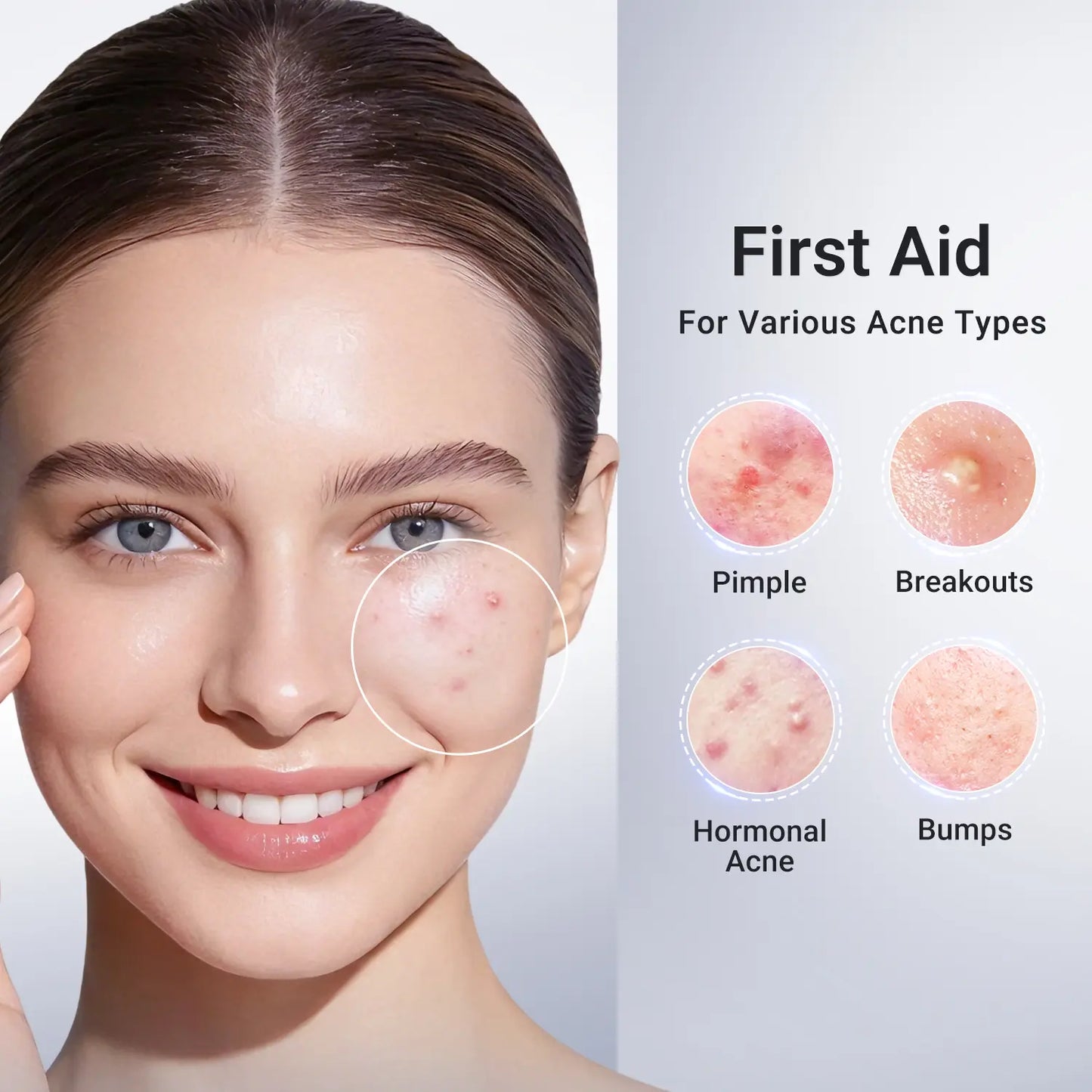 Drying Lotion Plus | Acne & Pimple Treatment | Visibly Shrinks Pimples in 24 Hours & Helps Fade Acne Marks in 7 Days - A926