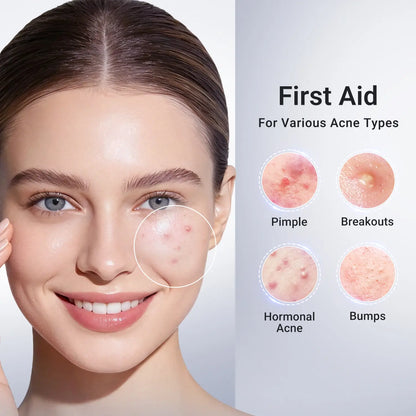 Drying Lotion Plus | Acne & Pimple Treatment | Visibly Shrinks Pimples in 24 Hours & Helps Fade Acne Marks in 7 Days - A926