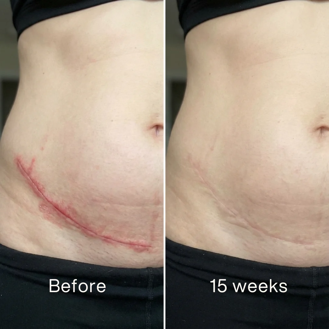 VERVEBEAD™ Silicon ScarStick Limited Time 75%OFF🔥LAST DAY⏰-W18