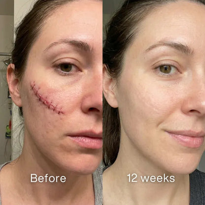 VERVEBEAD™ Silicon ScarStick Limited Time 75%OFF🔥LAST DAY⏰-W18