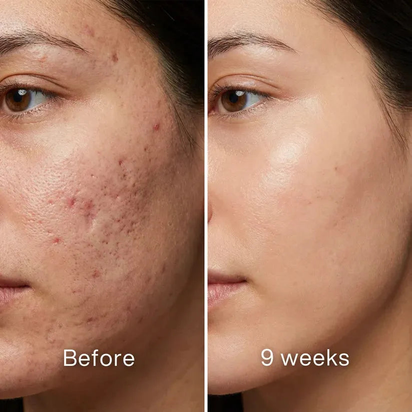 VERVEBEAD™ Silicon ScarStick Limited Time 75%OFF🔥LAST DAY⏰-W18