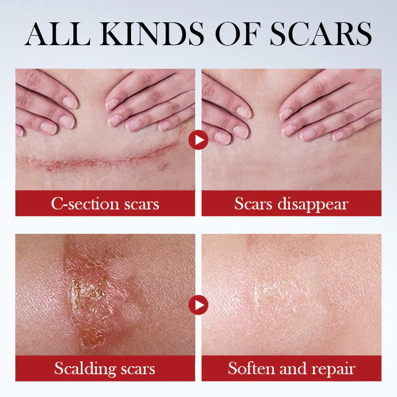 [Buy 1 Get 1 🔥]Repair Scar Cream🎁Smooth & Firm Skin, Reduce Wrinkles, Remove Dead Skin - Healing-ABB8